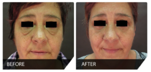 Blépharoplastie avant et après 300x144 - How long does a blepharoplasty last?