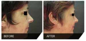 Blépharoplastie avant et après2 300x144 - How long does a blepharoplasty last?