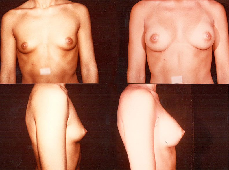 am5 - Breast augmentation