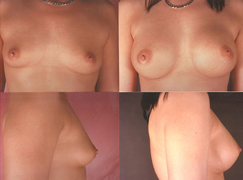 am8 - Breast augmentation