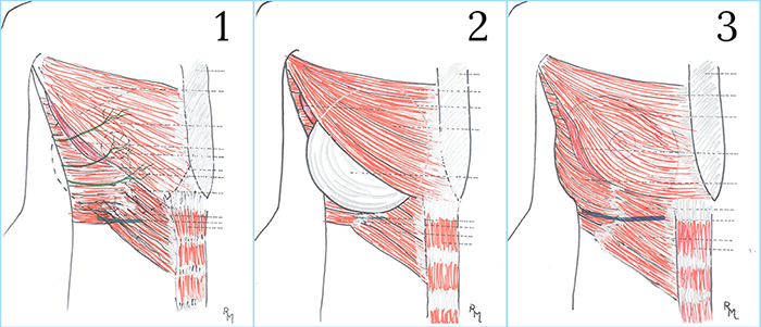 augmentationstep1 2 3 - Augmentation mammaire à apparence naturelle St-Jérôme