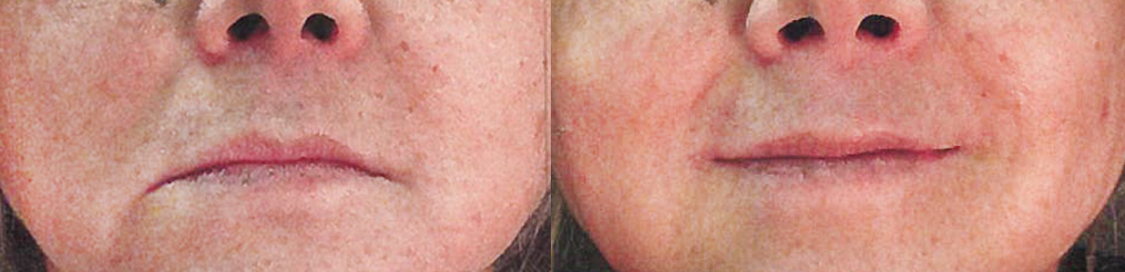 Le facelift smile ba - Le facelift