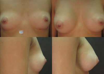 1 4 400x284 - Augmentation mammaire à apparence naturelle Longueuil