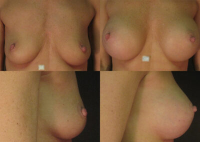 23 4 400x284 - Augmentation mammaire à apparence naturelle Granby
