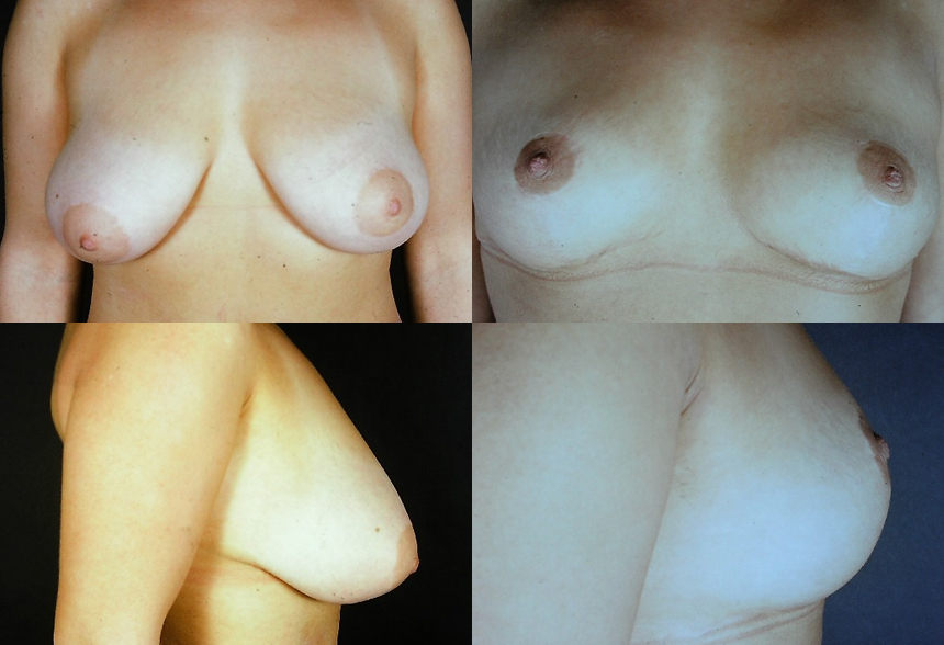 39 4 1 - Breast Reduction