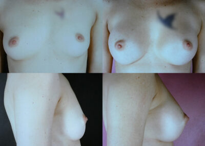 56 4 400x284 - Augmentation mammaire à apparence naturelle