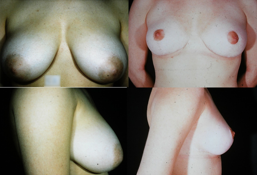 57 4 1 - Breast Reduction