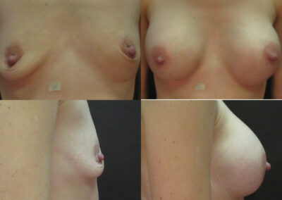 65 4 400x284 - Augmentation mammaire à apparence naturelle Granby