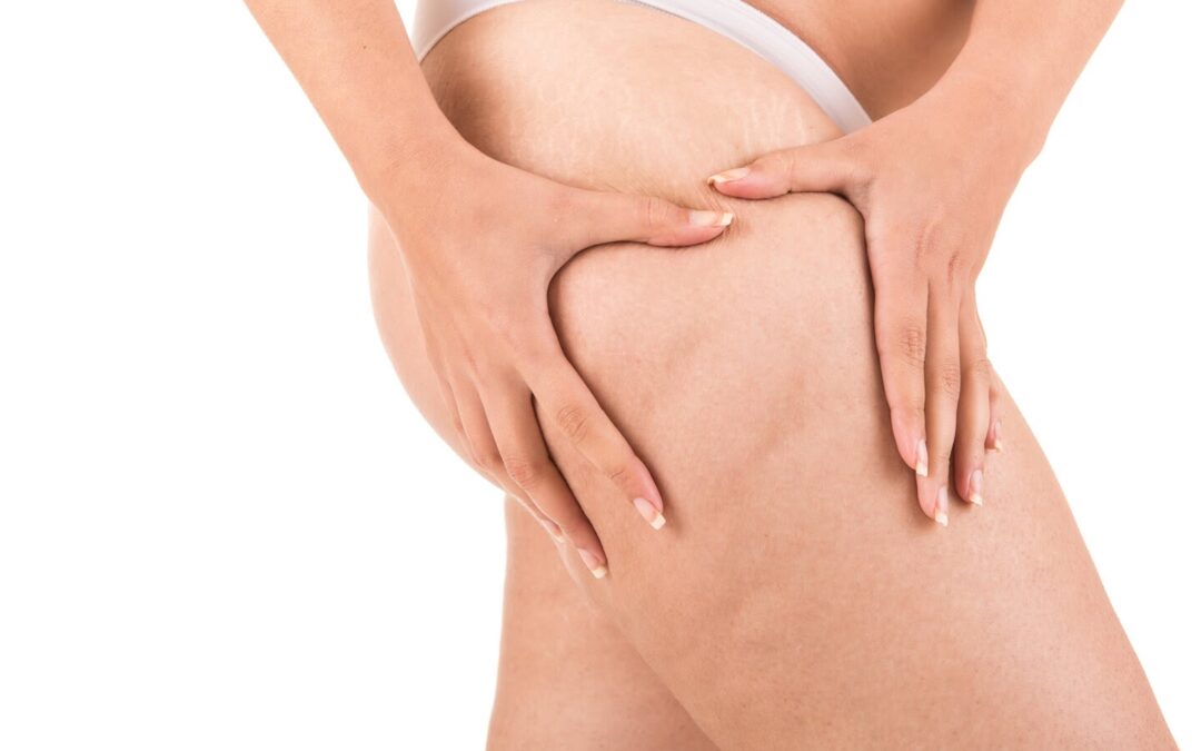How long does it take to recover from liposuction?