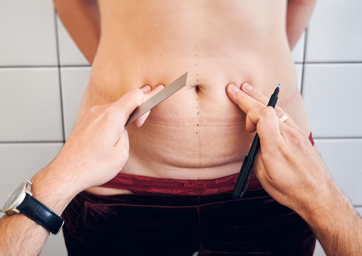 Everything you need to know about a mommy makeover
